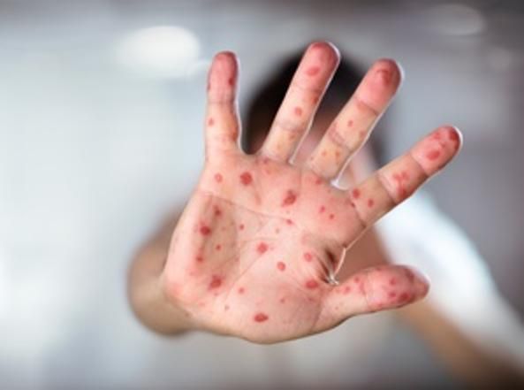 Measles alarm in Italy