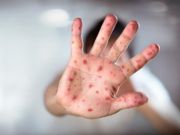 Measles alarm in Italy