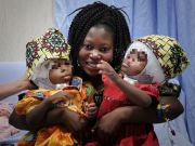 Rome doctors separate Siamese twins joined at head